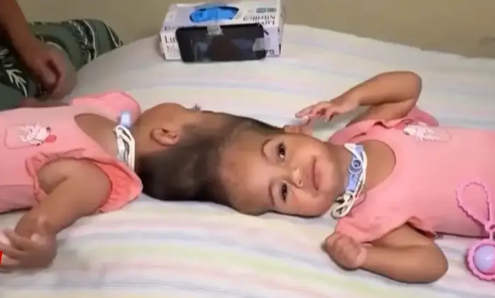 巴西一對頭部相連的2歲連體孿生姊妹赫洛伊薩（Heloísa）與赫蓮娜（Helena），歷經一年五次手術、醫療團隊15小時極致分離手術後，因體內血流與血壓劇烈失衡，相繼心臟驟停，經25分鐘搶救無效不幸離世，小小生命落幕令人不勝唏噓。（來源：g1）
