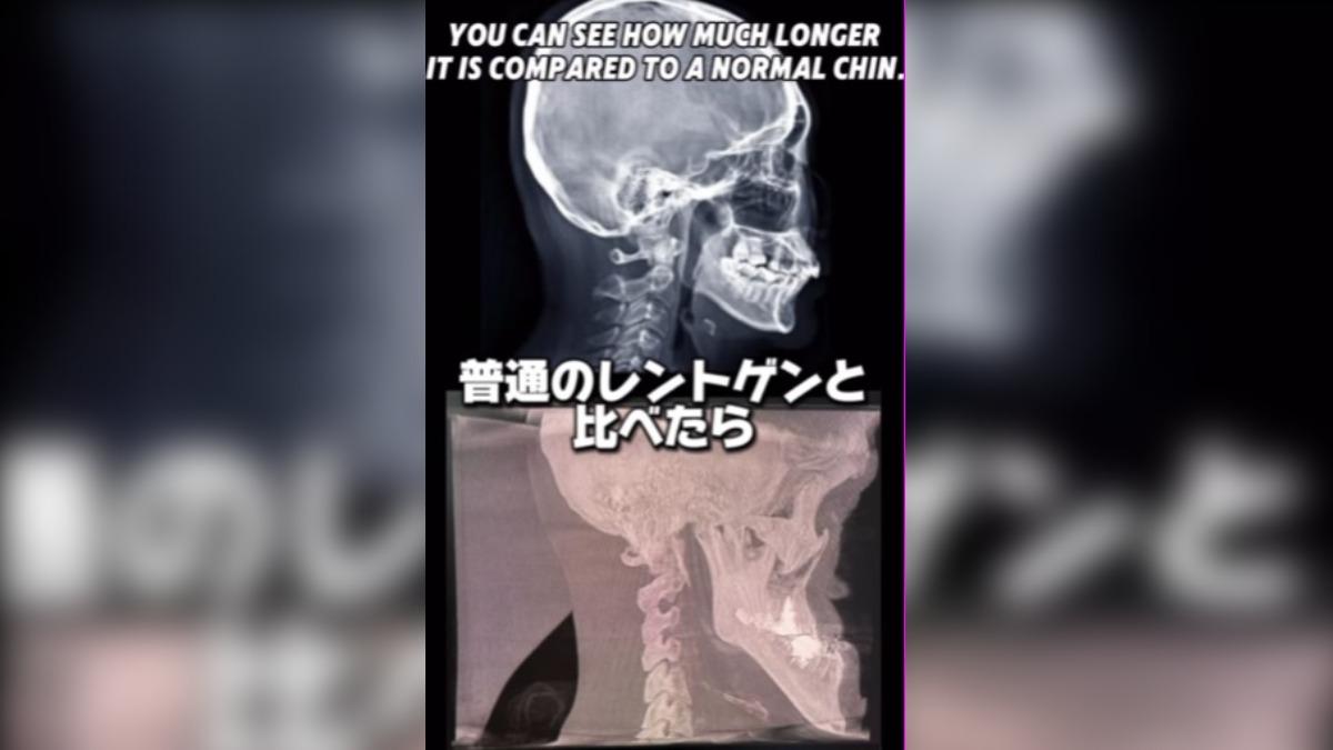 日本網紅城之內因長下巴受關注，拍 X 光片發現其下巴長度與角度獨特。（來源：agonagasugi_ •@IG）