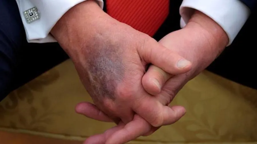 特朗普患慢性靜脈功能不全　雙手瘀傷引發外界健康關注的封面圖片