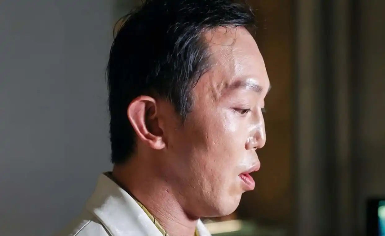 陳柏熹的外貌已恢復至受傷前的八成，但鼻子仍有輕微變形下陷，他坦言出事初期曾不願照鏡，但靠自我調節走了出來，並未尋求心理醫生幫助。(圖：網絡翻攝)