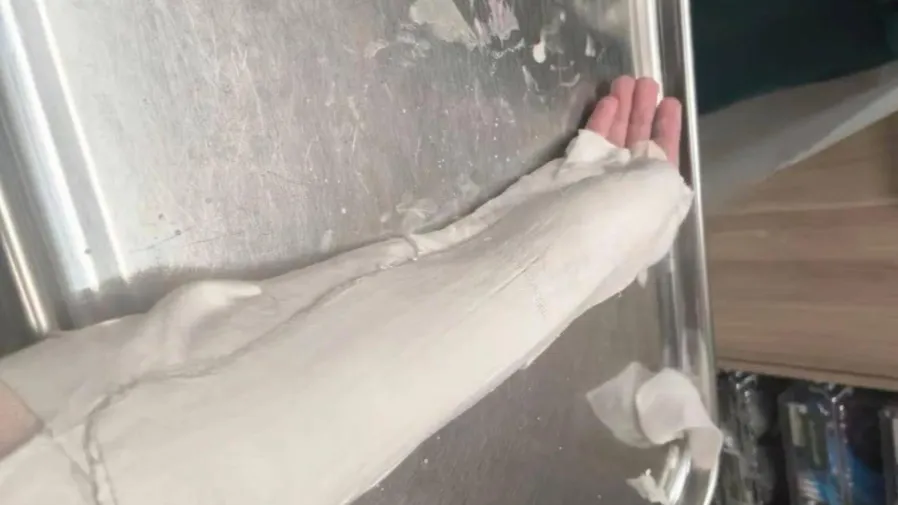 中國留學生吃麥當勞被搶薯條，手指受重傷，竟憑一己之力造出「救命AI」的封面圖片