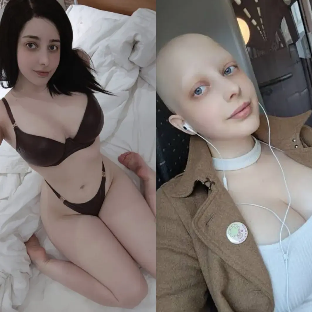 比利時模特兒、OnlyFans創作者霍姬娜（Mikomi Hokina）拍片時遭同行意外發現胸部腫塊，進而確診乳癌。她攜帶高風險BRCA1基因，歷經突發確診、化療落髮困境，最終以幽默心態抗癌成功。（來源：FB）