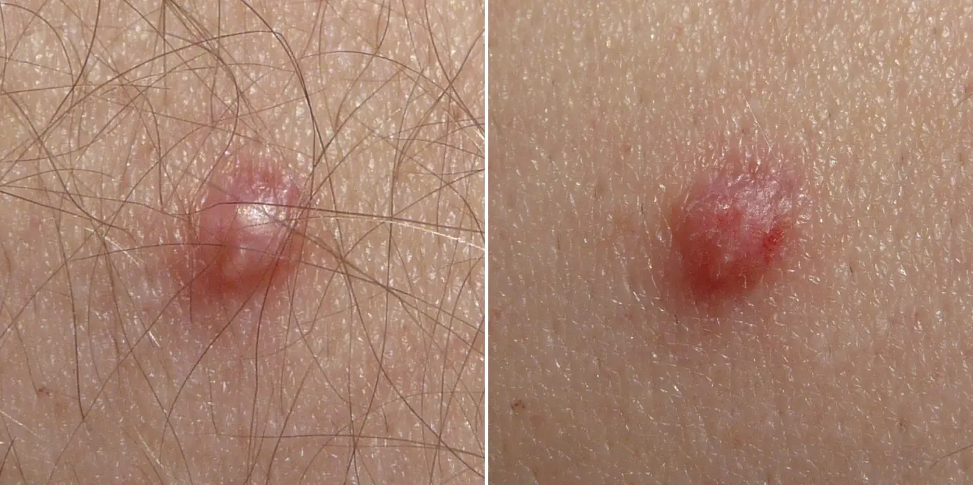 乳突瘤（來源：wikipedia）