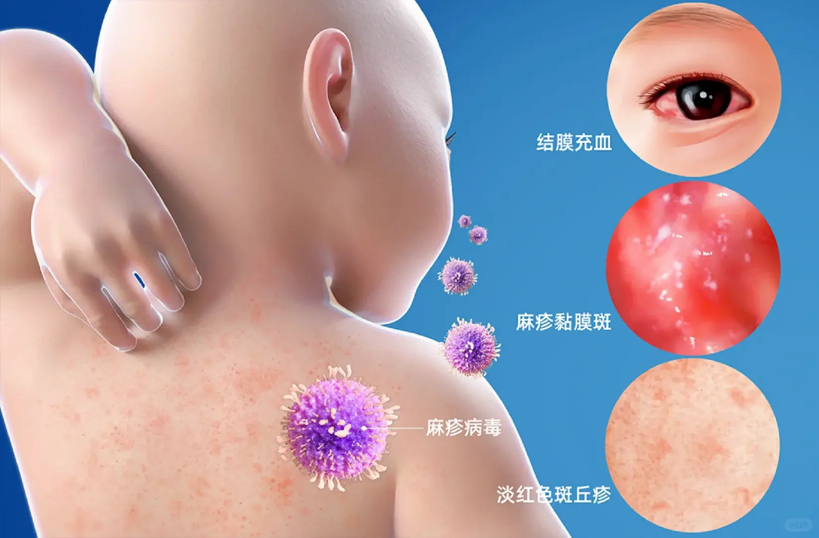 麻疹（measles）是由麻疹病毒引起的急性呼吸道傳染病，主要透過咳嗽、打噴嚏產生的飛沫與空氣傳播。傳染力極強，感染後常出現發燒、皮疹及口腔內灰白色斑點等癥狀。（示意圖來源：小紅書網友）
