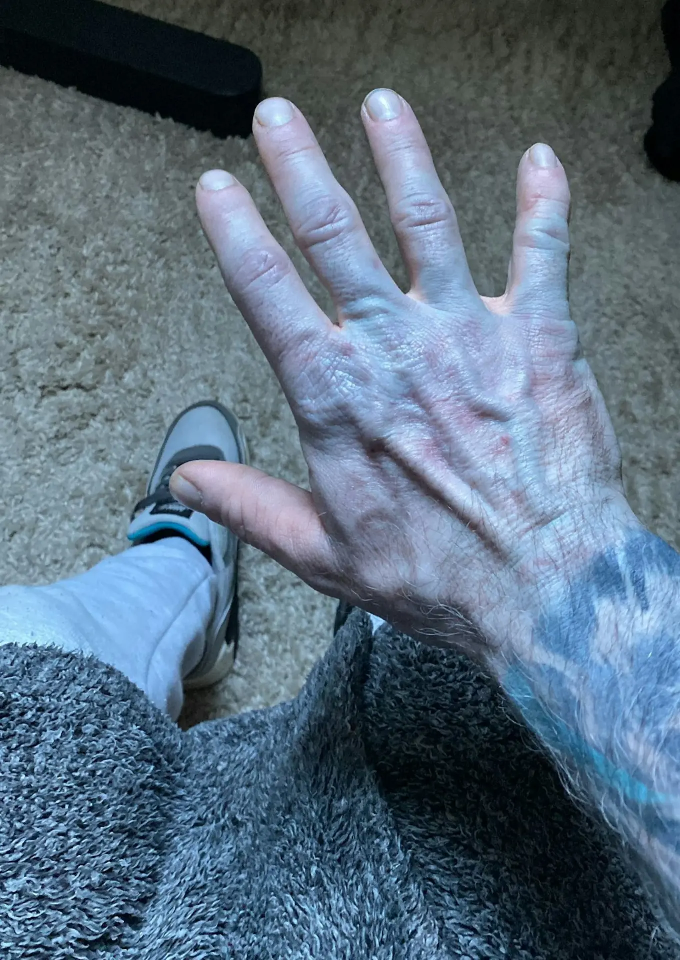 英國42歲男子林奇（Tommy Lynch）裸睡後全身變藍如《阿凡達（Avatar）》納美人，慌亂就醫，後發現因未洗新床單染色，其白斑癥讓染色更明顯。（來源：Tommy Lynch@FB)