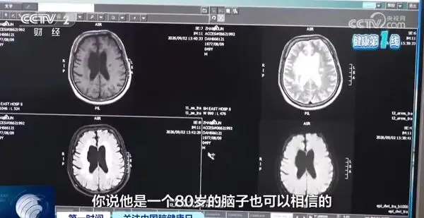 上海一名49歲張姓男子長期熬夜滑手機、作息紊亂，突發中風右手無力。經救治保命，卻出現嚴重腦損傷，大腦萎縮如80歲老人，確診血管性失智癥，留下不可逆認知障礙。（來源：新浪微博）