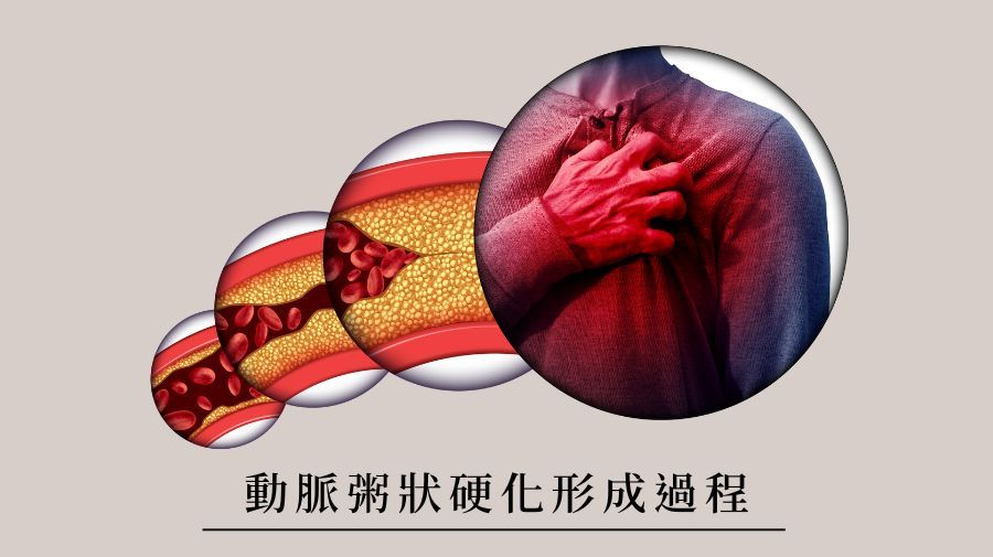 動脈粥狀硬化形成過程
