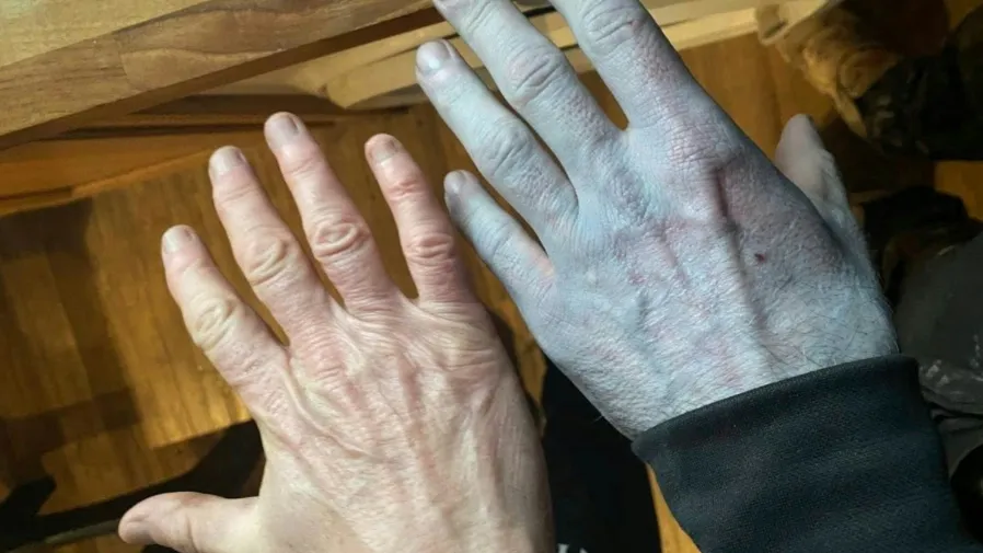 睡一覺變成「阿凡達」？42歲英男全身藍透，急診室查出離譜真相的封面圖片