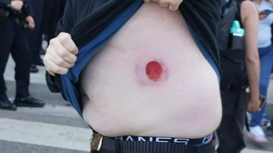 洛杉磯騷亂|多國記者被橡皮子彈擊中的封面圖片