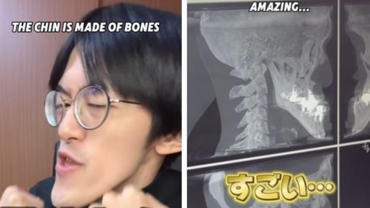日本網紅城之內因長下巴受關注，拍 X 光片發現其下巴長度與角度獨特。（來源：agonagasugi_ •@IG）