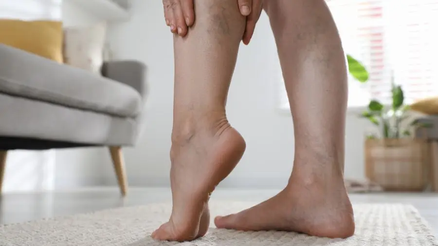 最常見的症狀就是腳踝、小腿、手部、眼皮或臉部出現水腫