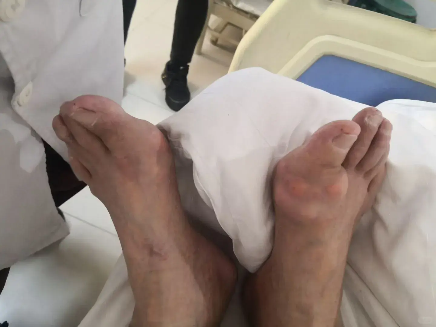 痛風患者的手和腳的關節。（示意圖來源：小紅書網友）