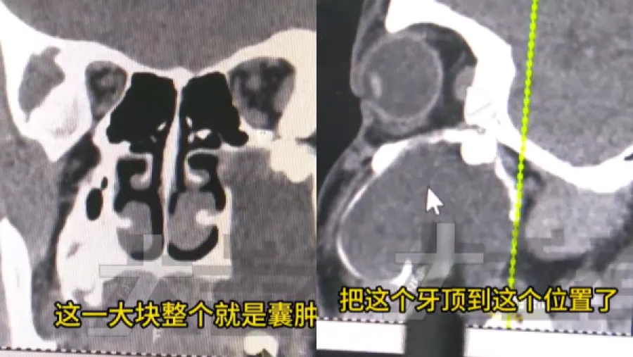 內地15歲少年臉腫嘴歪，竟是智齒長到眼窩？母親坦言一開始以為只是吃胖！的封面圖片