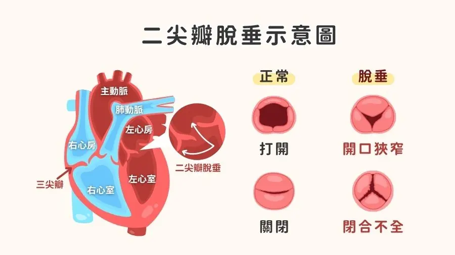 二尖瓣脫垂示意圖