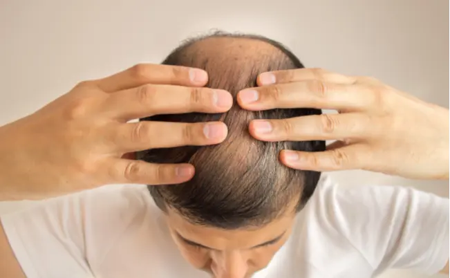 健保赤字高達11.4兆還要補助禿頭藥？韓總統提案嚇傻網友！（示意圖來源：images）