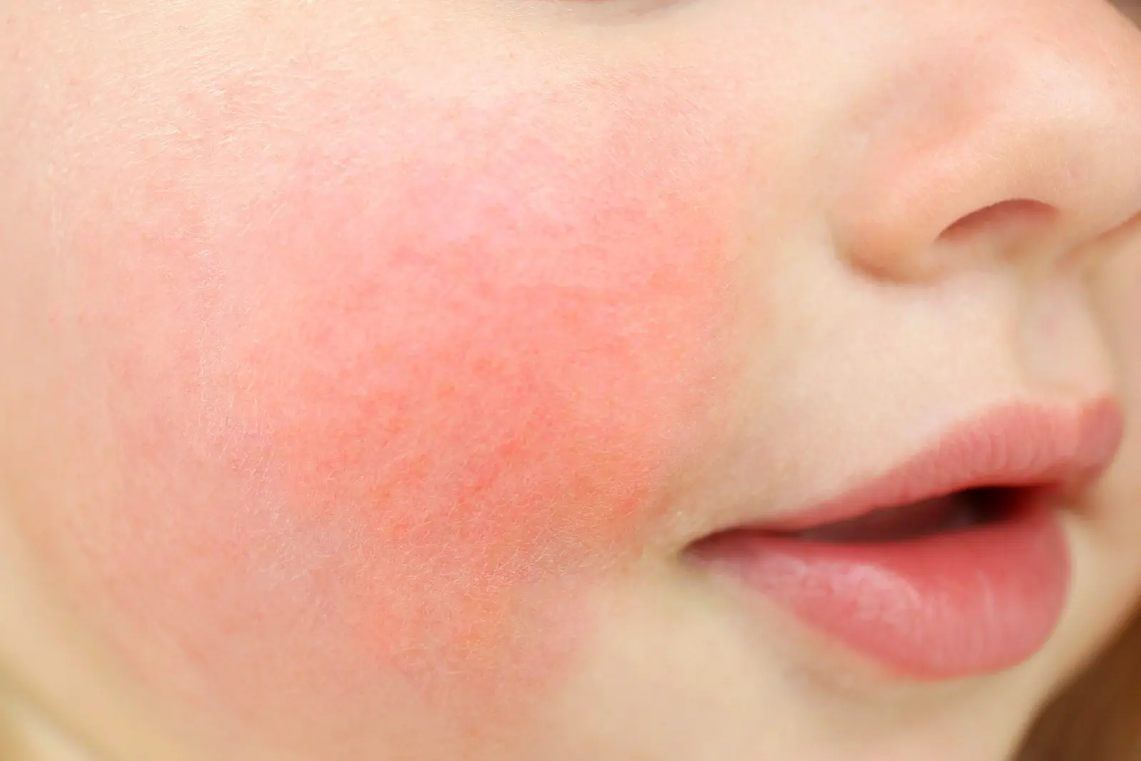 日本那霸市 6 家指定的小兒科醫療機構共通報了 12 例「蘋果病」病例。(圖：網絡翻攝)