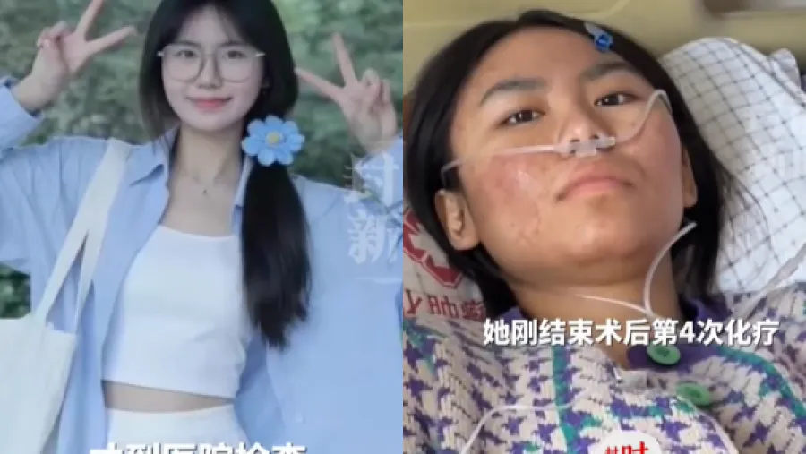 內地甜美研究生便血誤當痔瘡，確診大腸癌晚期仍微笑抗爭的封面圖片