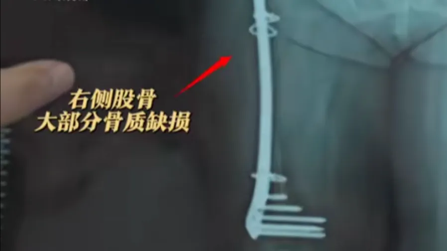 中國15歲女孩摔傷後大腿骨竟被身體「慢慢吃掉」,四次植骨全溶解!的封面圖片