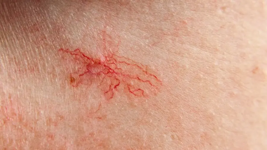 肝臟代謝荷爾蒙與凝血因子的功能下降時，皮膚會率先透露異常。