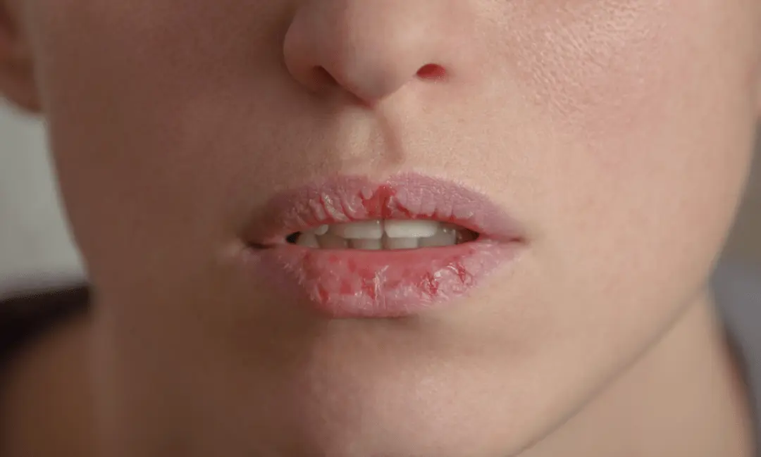 冬天一到，不少人就被嘴唇問題纏上——要麼幹得起皮，要麼裂出小縫，嚴重時甚至流血，塗再多潤唇膏都像「隔靴搔癢」。（示意圖來源：網絡）