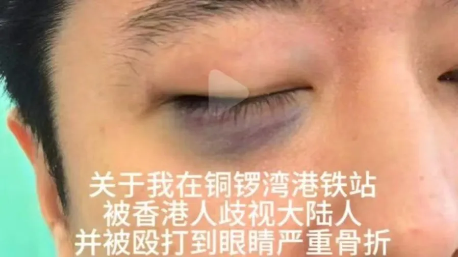 港鐵銅鑼灣站暴力事件：內地男子稱遭本地人歧視並重傷 打傷眼部引發關注的封面圖片