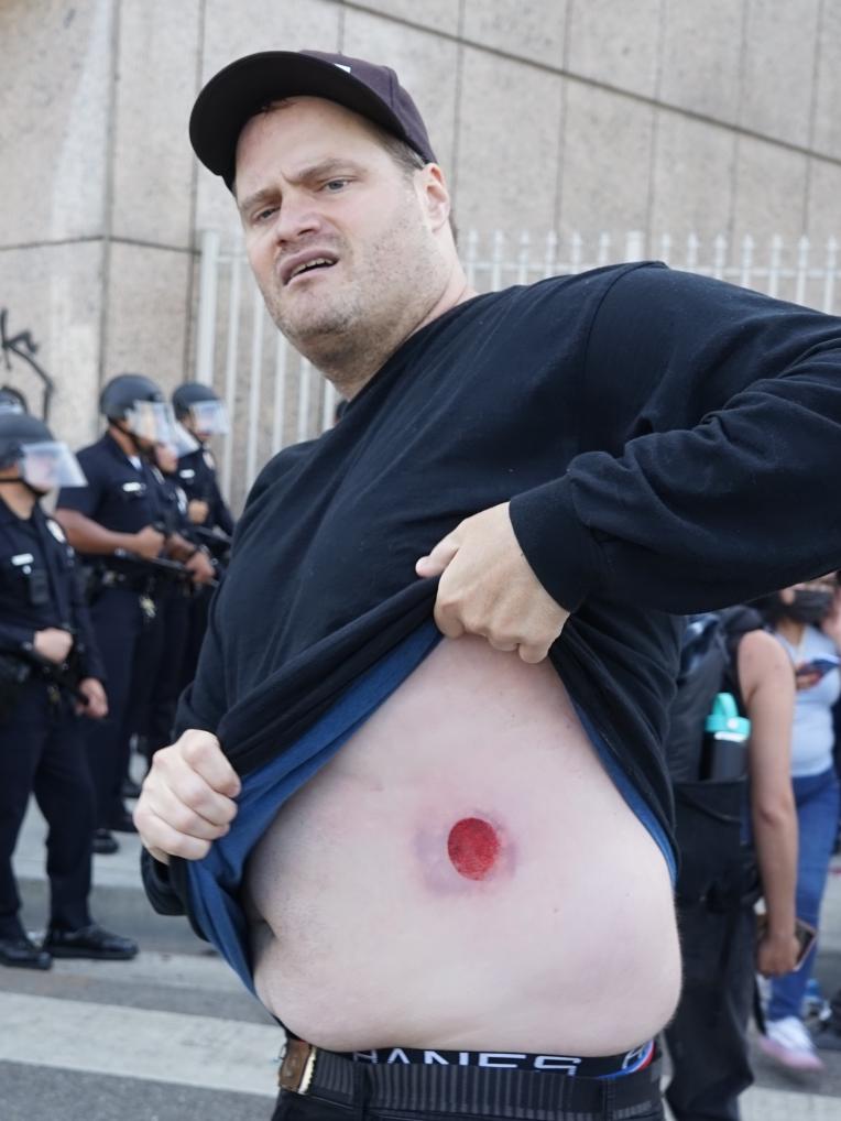 6月8日，在美國加利福尼亞州洛杉磯市中心，一名抗議者展示遭警方槍械擊中後留下的傷痕。新華社發（邱晨攝）