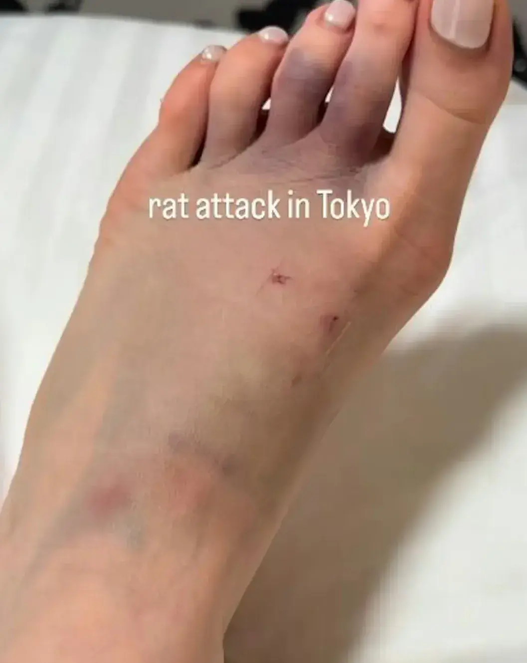 傷口呈現發黑瘀青狀態，齒痕清晰可見，她直言：「以後不能再說東京很乾淨了」，這場意外讓她的旅遊心情盡毀。​​（圖：yogitutty@IG）