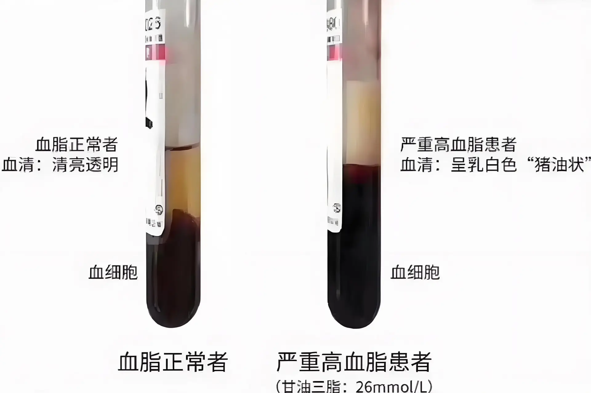 抽出的血液呈乳白色乳糜狀，確診為高脂血症性急性胰腺炎，隨即被轉入 EICU 搶救，目前仍在恢復中。​(圖：網絡翻攝)