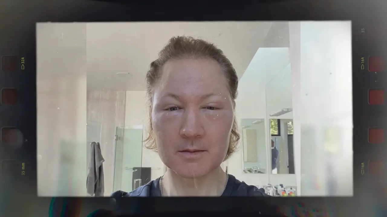 原本希望通過這項手術塑造年輕的面部輪廓,結果術後面部嚴重腫脹,甚至無法正常睜眼,腫脹症狀長達七天才逐漸消退。(來源: Bryan Johnson@YouTube)