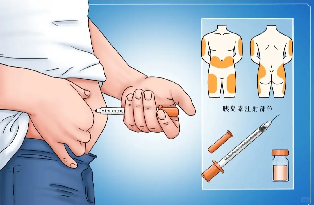 對千萬糖尿病患者來說，胰島素注射或許是難以擺脫的日常。（示意圖來源：小紅書網友）